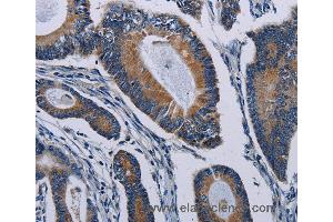 Immunohistochemistry of Human colon cancer using PCDHAC2 Polyclonal Antibody at dilution of 1:50 (PCDHAC2 anticorps)