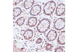 Immunohistochemistry of paraffin-embedded human colon using S100 antibody (ABIN7270126) at dilution of 1:100 (40x lens). (S100A5 anticorps  (AA 1-92))