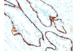 Formalin-fixed, paraffin-embedded human Prostate Carcinoma stained with Cytokeratin 15 Mouse Monoclonal Antibody (KRT15/2554).