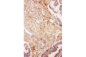 Anti-Diubiquitin antibody, IHC(P) IHC(P): Human Intestinal Cancer Tissue (UBD anticorps  (N-Term))