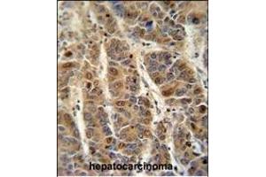 C4B antibody (C-term) (ABIN652149 and ABIN2840567) immunohistochemistry analysis in formalin fixed and raffin embedded human hetocarcinoma followed by peroxidase conjugation of the secondary antibody and DAB staining. (C4BPA anticorps  (C-Term))