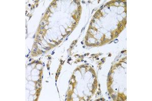Immunohistochemistry of paraffin-embedded human colon carcinoma using FBXL5 antibody at dilution of 1:100 (x40 lens). (FBXL5 anticorps)