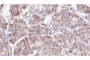 ABIN6276808 at 1/100 staining Human Melanoma tissue by IHC-P. (CCL4 anticorps  (Internal Region))