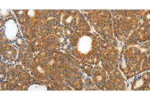 Immunohistochemistry of paraffin-embedded Human thyroid cancer using PRDX3 Polyclonal Antibody at dilution of 1:50 (Peroxiredoxin 3 anticorps)