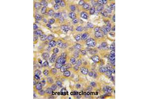 Formalin-fixed and paraffin-embedded human breast carcinoma tissue reacted with DKK3 polyclonal antibody  , which was peroxidase-conjugated to the secondary antibody, followed by DAB staining. (DKK3 anticorps  (N-Term))