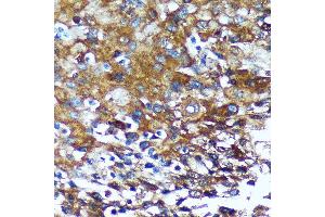 Immunohistochemistry of paraffin-embedded Human esophageal cancer using GRSF1 Rabbit pAb (ABIN7267319) at dilution of 1:100 (40x lens). (GRSF1 anticorps)