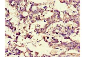 Immunohistochemistry of paraffin-embedded human gastric cancer using ABIN7159937 at dilution of 1:100 (BRP44 anticorps  (AA 1-40))