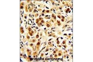 Formalin-fixed and paraffin-embedded human prostate carcinoma with GDH Antibody (C-term ), which was peroxidase-conjugated to the secondary antibody, followed by DAB staining. (GAPDH anticorps  (C-Term))