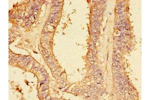 Immunohistochemistry of paraffin-embedded human endometrial cancer using ABIN7149414 at dilution of 1:100 (PLA2G4A anticorps  (AA 379-533))