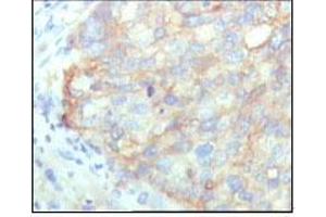 Immunohistochemical analysis of paraffin-embedded human cervical carcinoma, showing cytoplasmic localization with DAB staining using KARS mouse mAb. (KARS anticorps)
