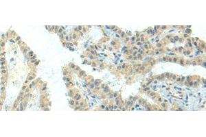 Immunohistochemistry of paraffin-embedded Human thyroid cancer tissue using NPVF Polyclonal Antibody at dilution of 1:80(x200) (NPVF anticorps)