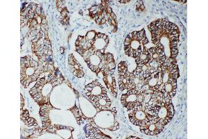Anti-TJP2 antibody, IHC(P) IHC(P): Human Intestinal Cancer Tissue (TJP2 anticorps  (C-Term))