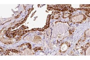 ABIN6267196 at 1/100 staining Human thyroid cancer tissue by IHC-P.