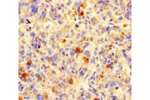 Immunohistochemistry of paraffin-embedded human melanoma using ABIN7161076 at dilution of 1:100