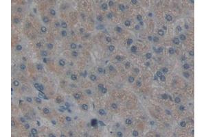 DAB staining on IHC-P; Samples: Human Liver cancer Tissue