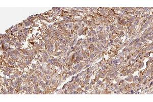 ABIN6279301 at 1/100 staining Human Melanoma tissue by IHC-P. (CMTM7 anticorps  (Internal Region))