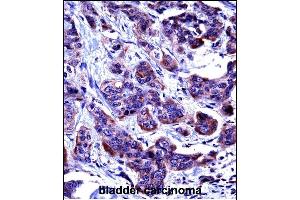 CASP6 Antibody (N-term) ((ABIN657756 and ABIN2846738))immunohistochemistry analysis in formalin fixed and paraffin embedded human bladder carcinoma followed by peroxidase conjugation of the secondary antibody and DAB staining.