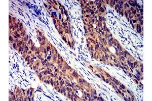 Immunohistochemical analysis of paraffin-embedded cervical cancer tissues using CD100 mouse mAb with DAB staining.