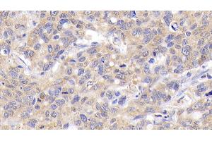 Detection of Bcl2 in Human Lymphoma Tissue using Monoclonal Antibody to B-Cell Leukemia/Lymphoma 2 (Bcl2)