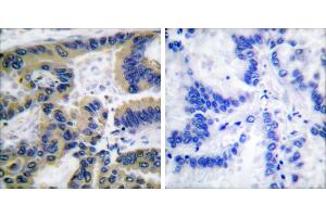 Cl-peptide - +Immunohistochemical analysis of paraffin-embedded human lung carcinoma tissue using Caspase 7 (cleaved-Asp198) antibody. (Caspase 7 anticorps  (Cleaved-Asp198))