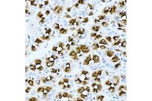 Immunohistochemical analysis of ASMTL staining in human gastric cancer formalin fixed paraffin embedded tissue section.