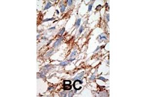 Formalin-fixed and paraffin-embedded human cancer tissue reacted with the primary antibody, which was peroxidase-conjugated to the secondary antibody, followed by DAB staining.