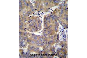 EIF3H Antibody immunohistochemistry analysis in formalin fixed and paraffin embedded human hepatocarcinoma followed by peroxidase conjugation of the secondary antibody and DAB staining. (EIF3H anticorps  (N-Term))