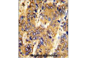 Formalin-fixed and paraffin-embedded human hepatocarcinoma with MSRB2 Antibody , which was peroxidase-conjugated to the secondary antibody, followed by DAB staining. (MSRB2 anticorps  (AA 44-73))