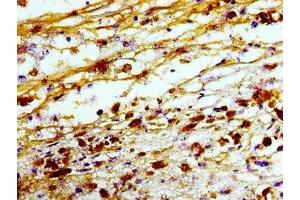 Immunohistochemistry of paraffin-embedded human melanoma using ABIN7173382 at dilution of 1:100 (TREM2 anticorps  (AA 19-174))