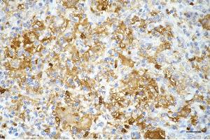 Immunohistochemistry was performed on paraffin-embedded human hepatocarcinoma using phosphogluconate dehydrogenase antibody (ABIN7799807), 1:200). (Recombinant PGD anticorps)