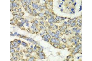 Immunohistochemistry of paraffin-embedded Human esophageal cancer using TUFM Polyclonal Antibody at dilution of 1:100 (40x lens). (TUFM anticorps)