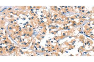 Immunohistochemistry of paraffin-embedded Human thyroid cancer tissue using SLC6A4 Polyclonal Antibody at dilution of 1:30 (SLC6A4 anticorps)
