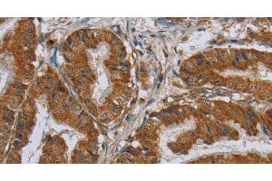 Immunohistochemistry of paraffin-embedded Human esophagus cancer using CSH1 Polyclonal Antibody at dilution of 1:40 (CSH1 anticorps)