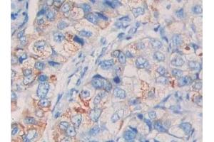 Detection of CD10 in Human Breast cancer Tissue using Polyclonal Antibody to Neprilysin (CD10)