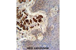 COL19A1 antibody (N-term) immunohistochemistry analysis in formalin fixed and paraffin embedded human skin carcinoma followed by peroxidase conjugation of the secondary antibody and DAB staining.
