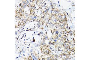Immunohistochemistry of paraffin-embedded human breast cancer using R Rabbit pAb (ABIN3017320, ABIN3017321, ABIN3017322 and ABIN6220039) at dilution of 1:200 (40x lens). (RAMP2 anticorps  (AA 1-145))