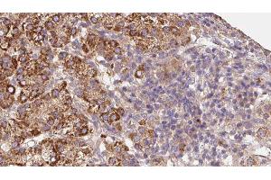ABIN6279677 at 1/100 staining Human liver cancer tissue by IHC-P. (KCNG4 anticorps  (Internal Region))