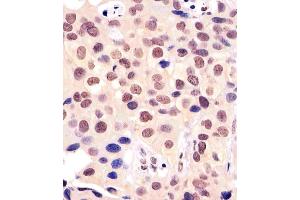 (ABIN6242199 and ABIN6577161) staining BANP in human breast carcinoma tissue sections by Immunohistochemistry (IHC-P - paraformaldehyde-fixed, paraffin-embedded sections). (BANP anticorps  (AA 30-390))