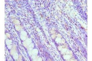Immunohistochemistry of paraffin-embedded human colon cancer using ABIN7160088 at dilution of 1:100 (MAD2L1 anticorps  (AA 1-205))