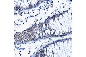 Immunohistochemistry of paraffin-embedded human colon using RPP25 Rabbit pAb (ABIN6133248, ABIN6147176, ABIN6147177 and ABIN6225317) at dilution of 1:100 (40x lens). (RPP25 anticorps  (AA 1-199))