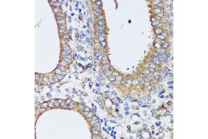 Immunohistochemistry of paraffin-embedded human uterine cancer using ERK1 / ERK2 antibody (ABIN7268619) at dilution of 1:200 (40x lens). (ERK1 anticorps  (AA 200-300))