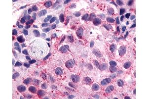 Anti-NPFFR1 / GPR147 antibody IHC of human Breast, Carcinoma. (NPFFR1 anticorps  (C-Term))