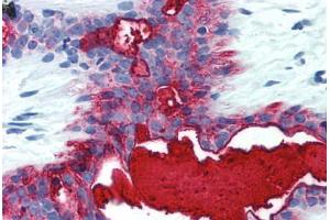 Human Breast (formalin-fixed, paraffin-embedded) stained with MUC1 antibody ABIN396912 at 5 ug/ml followed by biotinylated anti-mouse IgG secondary antibody ABIN481714, alkaline phosphatase-streptavidin and chromogen. (MUC1 anticorps)