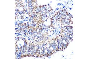 Immunohistochemistry of paraffin-embedded human colon carcinoma using IDH2 Rabbit mAb (ABIN7268028) at dilution of 1:100 (40x lens). (IDH2 anticorps)