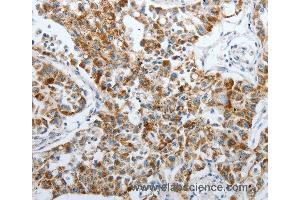 Immunohistochemistry of Human lung cancer using PDK2 Polyclonal Antibody at dilution of 1:40