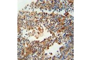 Immunohistochemistry analysis in formalin fixed and paraffin embedded human lung carcinoma reacted with OR9Q1 Antibody (C-term) Cat. (OR9Q1 anticorps  (C-Term))