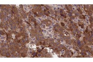 ABIN6277375 at 1/100 staining Human liver cancer tissue by IHC-P. (GLRA1 anticorps  (Internal Region))