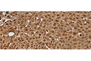 Immunohistochemistry of paraffin-embedded Human lung cancer tissue using LAMTOR5 Polyclonal Antibody at dilution of 1:35(x200) (HBXIP anticorps)