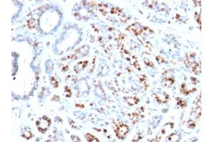 Formalin-fixed, paraffin-embedded human Breast Carcinoma stained with GATA-3 Mouse Monoclonal Antibody (GATA3/2444). (GATA3 anticorps  (AA 357-436))