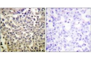 Immunohistochemistry analysis of paraffin-embedded human breast carcinoma, using PAK1/2/3 (Phospho-Thr423/402/421) Antibody. (PAK1/2/3 anticorps  (pThr423))